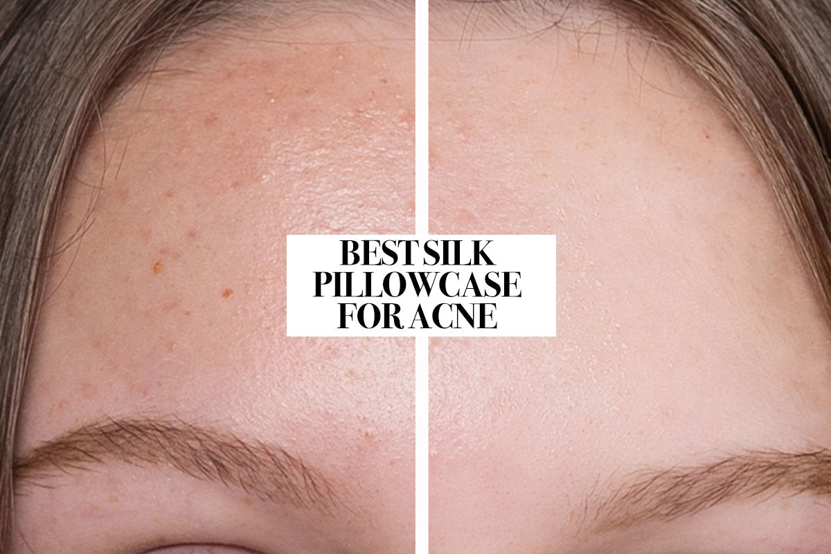 Young girl showing the difference in her acne before and after sleeping on a silk pillowcase.